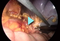 filmato splenectomia
