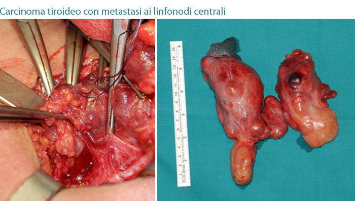 carcinoma tiroideo