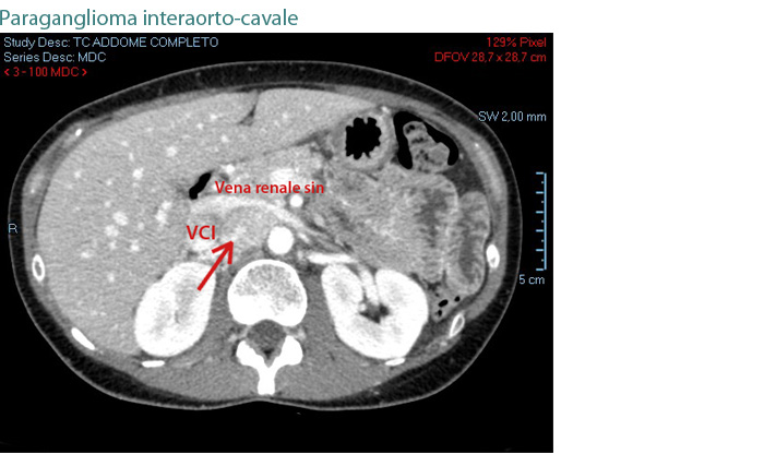paraganglioma interaorto-cavale